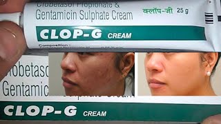 CLOP  G Cream  Skin Whitening Creams  CLOP  G Cream review and benefit kannada videos [upl. by Ennahtebazile]