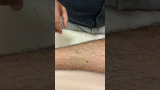 Local Treatment for Shin Splints [upl. by Quiteri]