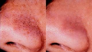 HOW TO GET RID OF BLACKHEADS [upl. by Jesselyn674]