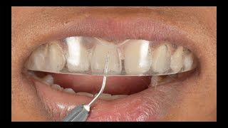 Direct composite veneers  Injection moulding technique  Complete Digital Workflow [upl. by Timofei]