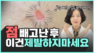 의사가 알려주는 점빼고 흉터 색소침착 남지 않는 후관리 방법  흉터 색소침착 [upl. by Laleb264]