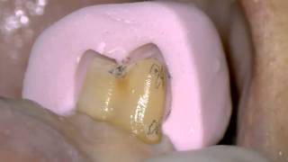 Tooth preparation of right premolar with microscope [upl. by Soelch]