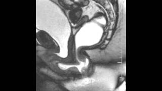 Dynamic Pelvic MRI showing rectocele Pelvic Floor Center of Orlando [upl. by Brodeur172]