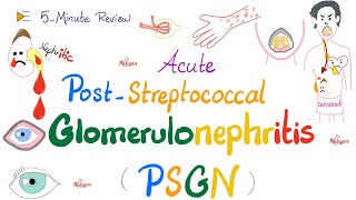 Acute PostStreptococcal Glomerulonephritis APSGN Nephritic Syndrome Kidney PathologyNephrology [upl. by Pena]