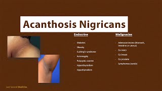 Acanthosis Nigricans  What is Acanthosis Nigricans amp What are its CAUSES [upl. by Fran]