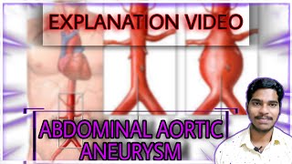 ABDOMINAL AORTIC ANEURYSM  EXPLAINED IN TAMIL [upl. by Maure]