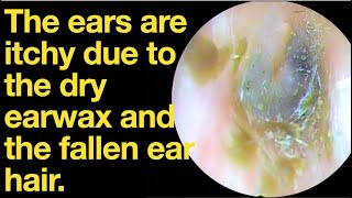 The ears are itchy due to the dry earwax and the fallen ear hairear wax removal  ASMR [upl. by Plume336]