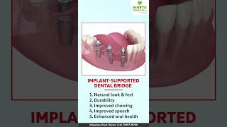 Dental Implant supported fixed bridge teeth [upl. by Naened878]