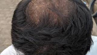 Minoxidil 5 Finasteride 1mg amp Derma roller 10mm  3 month hair grow result [upl. by Ecadnak]