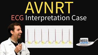 AV Nodal Reentry Tachycardia AVNRT on ECG  EKG [upl. by Ikciv514]