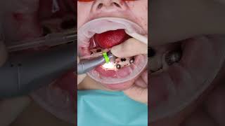 Dental implant’s All on 4 in Prague shorts dentist dental implant veneers short [upl. by Ettevy]