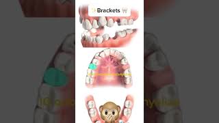 Second premolars extraction orthodontie kieferorthopädie orthodontics ortodonzia ortodoncia [upl. by Milissent]