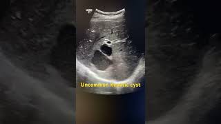 Hepatic cyst ultrasound ultrasonography [upl. by Ramberg]