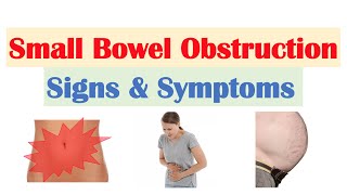 Small Bowel Obstruction SBO Signs amp Symptoms amp Why They Occur [upl. by Goodard]