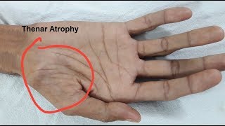 Thenar Atrophy in Motor Neuron Disease [upl. by Ayatal]