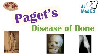 Paget’s Disease of Bone Osteitis Deformans  Causes Pathogenesis Symptoms Diagnosis amp Treatment [upl. by Etnoval822]