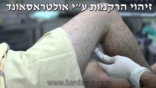 חסם עצבי סכיאטי פופליטאלי Sciatic popliteal block [upl. by Artkele165]