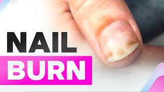 Nail Burn  Onycholysis  Clean Manicure [upl. by Okubo]