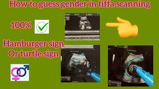 Gender prediction 👩🏻‍🍼tiffa scanning images babygirll baby boyguess gender🥰 [upl. by Jeffries]