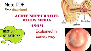 Acute Suppurative Otitis Media  ASOM  ENT  Easy explanation  Stages  Diagnosis  Management [upl. by Annua]