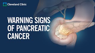 6 Warning Signs of Pancreatic Cancer [upl. by Asyen]