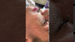 Fractional CO2 Laser Resurfacing [upl. by Waligore]