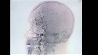 Right Lacerum Segment Stenosis Treated By Carotid Angioplasty And Stenting [upl. by Weatherley]