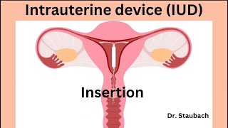 IUD Insertion What You NEED To Know ACTUAL FOOTAGE [upl. by Christiane]