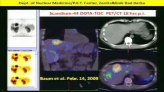 Neuroendocrine Tumors Diagnosis amp Treatment w Peptide Receptor RadiotherapyPRRT Dr Baum 2of2 [upl. by Fabian]