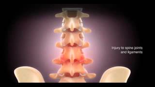 Remote controlled implant ReActiv8 relieves chronic back pain [upl. by Liss]