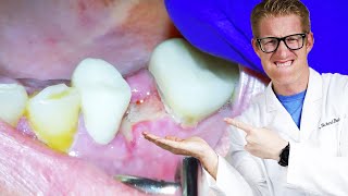 Dentist Explains TOOTH PAIN AFTER EXTRACTIONS Throbbing Dry Socket amp Aching For Days After [upl. by Ettenav]