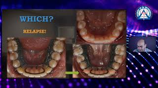 Monday Tip  Which is the BEST Orthodontic Retainer [upl. by Hullda]