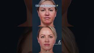 Revitalize Your Skin with CO2 Laser Resurfacing  The Ultimate Solution for Wrinkles and Scars [upl. by Marelda]