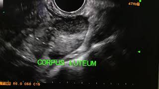 Corpus luteum with peripheral ring of fire USG U ltrasound [upl. by Zurciram]