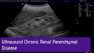 Ultrasound  How to Diagnose Chronic Renal Parenchymal Disease [upl. by Malcah783]