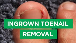 Ep 59 Ingrown Toenail Removal Procedure  The Scope [upl. by Nauj]