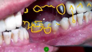 Edident Lab quotDental Upper six unit Porcelain Buildup Part 1quot [upl. by Adamson985]