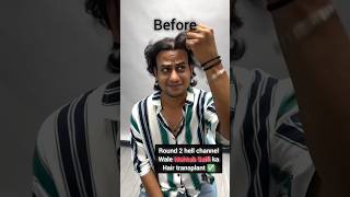 Mehtab saifi ka hair transplant R2h shorts [upl. by Itsyrc340]