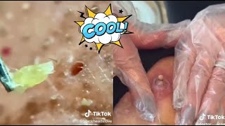 Ultimate Satisfying Acne Removal Compilation Best Pimple Pops Blackheads and Cysts [upl. by Kenison811]