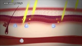 Metody leczenia łuszczycy terapia światłem UVB  PUVA  Janssen Polska [upl. by Notsruht]