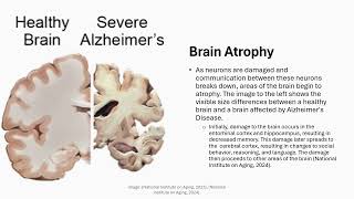 Pathophysiology Alzheimers Presentation [upl. by Verity]