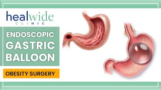 Gastric balloon  Endoscopic Gastric Balloon  nonsurgical weightloss procedure  in TURKEY [upl. by Oznol]