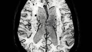 SWI in CAAcerebral Amyloid Angiopathy [upl. by Kokoruda76]