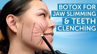 Botox for Jaw Slimming and Teeth Clenching  AAFE [upl. by Ettereve]