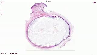 Epidermal Inclusion Cyst Atheroma  Histopathology [upl. by Audry]