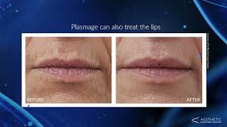 What Is Plasmage®  Introducing Fractional Plasma Technology To Treat Wrinkles amp Other Skin Concerns [upl. by Reider130]