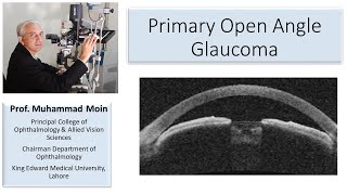 Eye Lectures Primary Angle Closure Glaucoma [upl. by Tevlev]