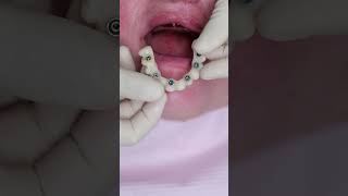 Dental implant’s All on 4 shorts smile impossible dentist best new beautiful shortvideo [upl. by Olegnaleahcim]