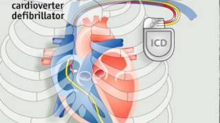 How pacemakers work [upl. by Pietra]