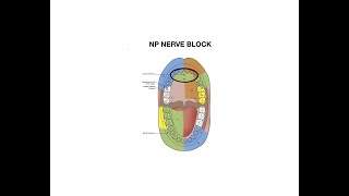 Nasopalatine Nerve Block Injection [upl. by Philip240]